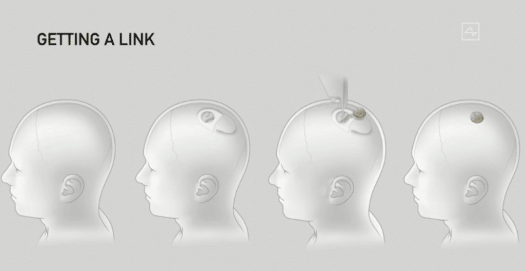 Neuralink на Мъск имплантира мозъчен чип на човек